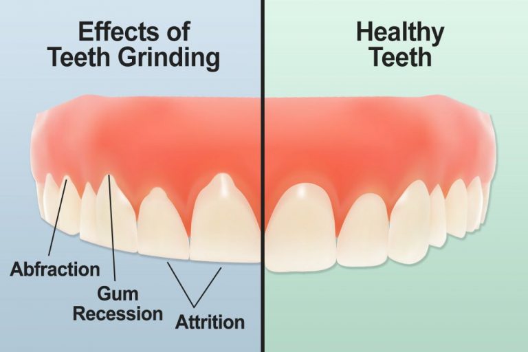 bruxism or teeth grinding